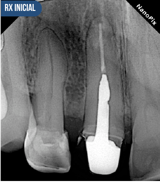 Radiografía de referencia de una cirugía apical, sin datos personales